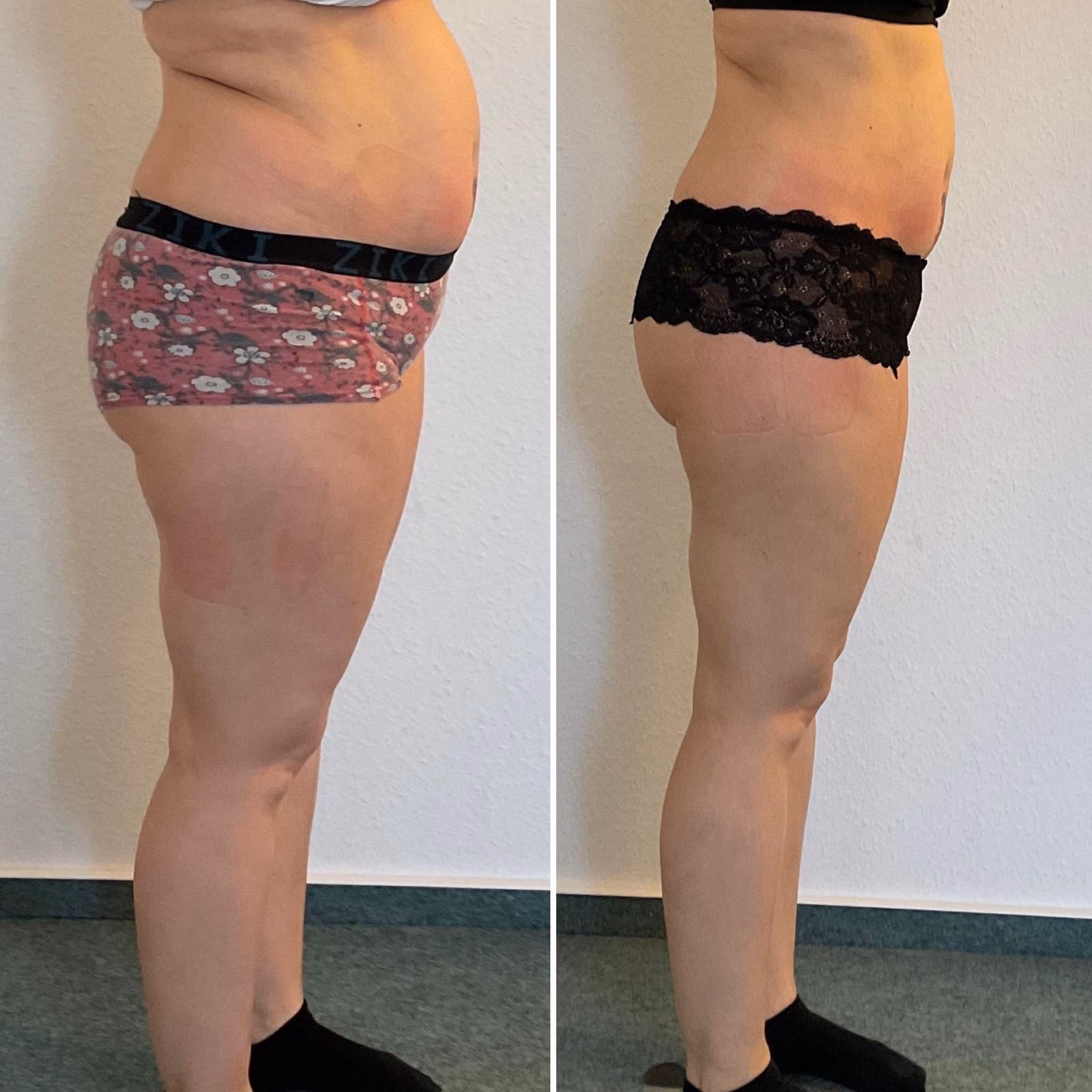 Vorher-Nachher-Vergleich einer Kundin: straffere Silhouette nach mehreren Behandlungen